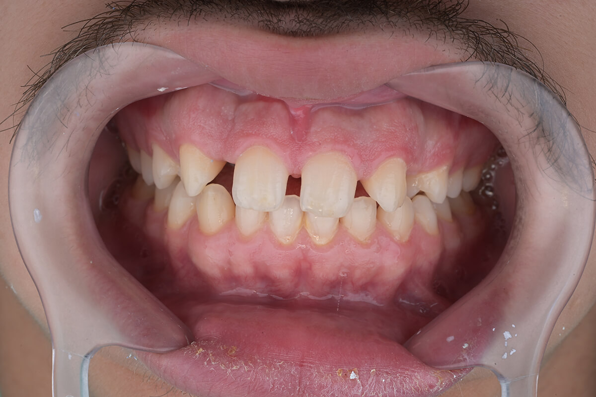 <span class="bt_bb_before_after_image_after_text">بعد</span>