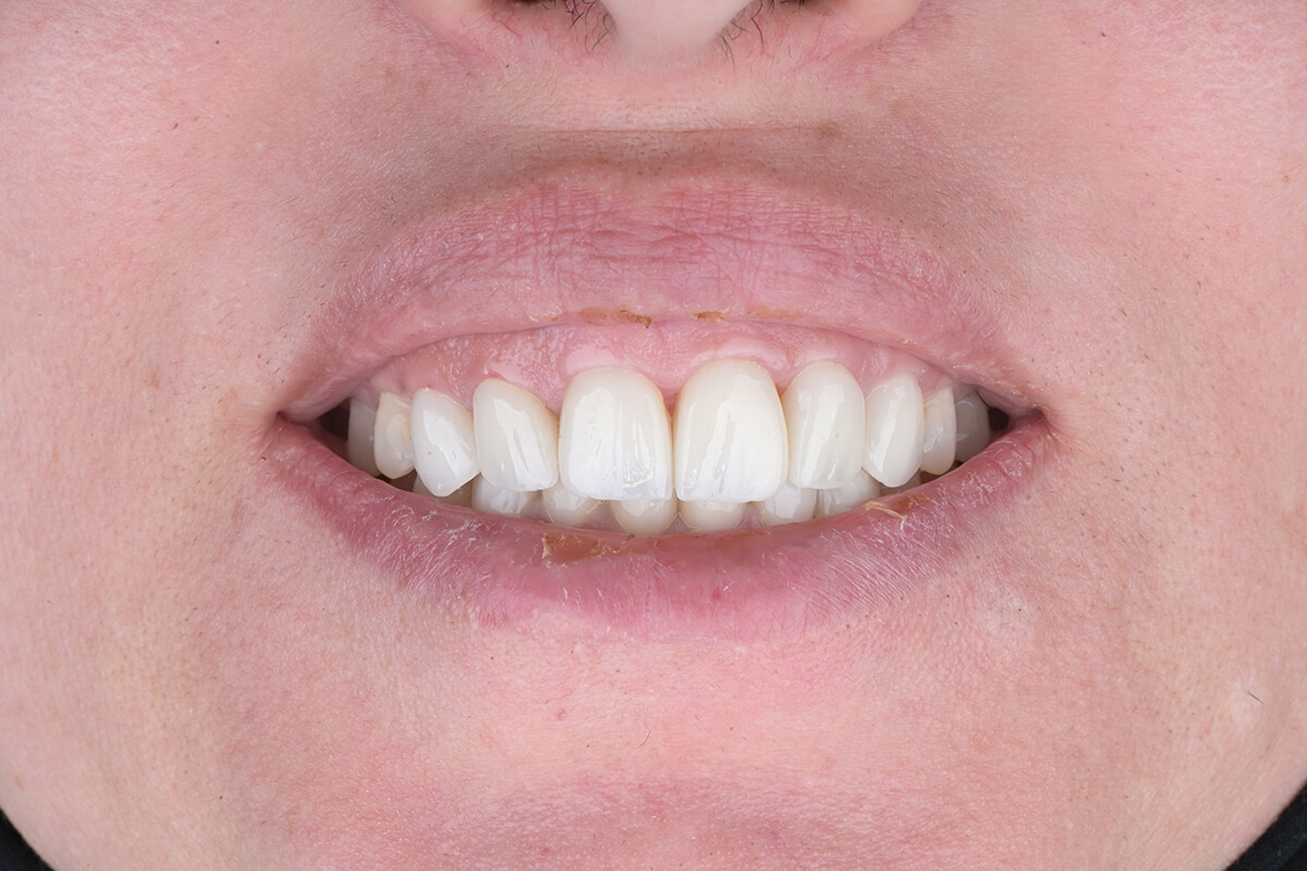 <span class="bt_bb_before_after_image_after_text">بعد</span>