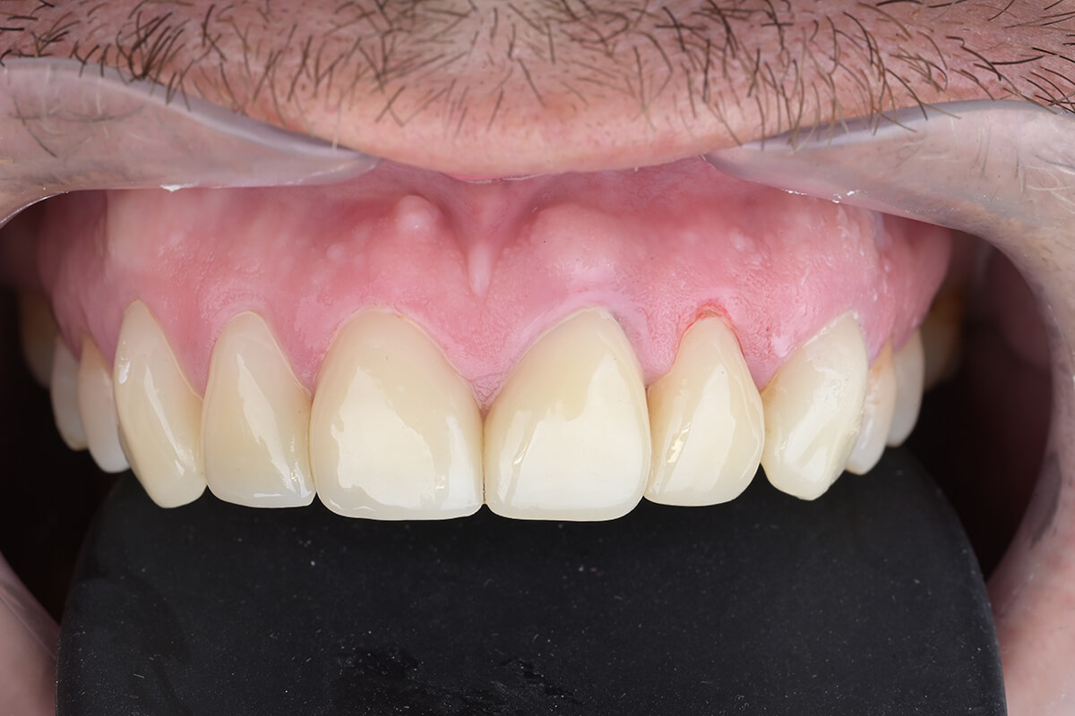 <span class="bt_bb_before_after_image_after_text">بعد</span>