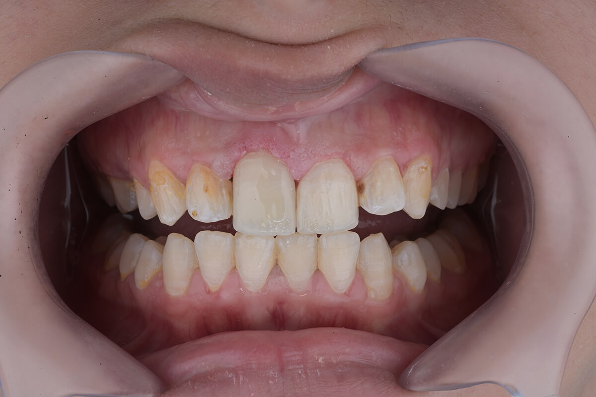 <span class="bt_bb_before_after_image_after_text">بعد</span>