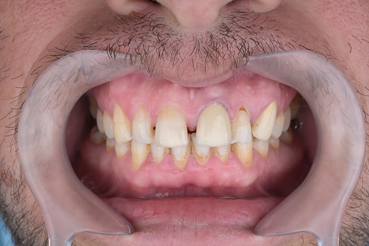 <span class="bt_bb_before_after_image_before_text">قبل</span>