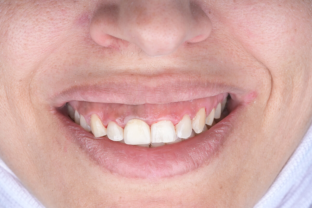 <span class="bt_bb_before_after_image_before_text">قبل</span>