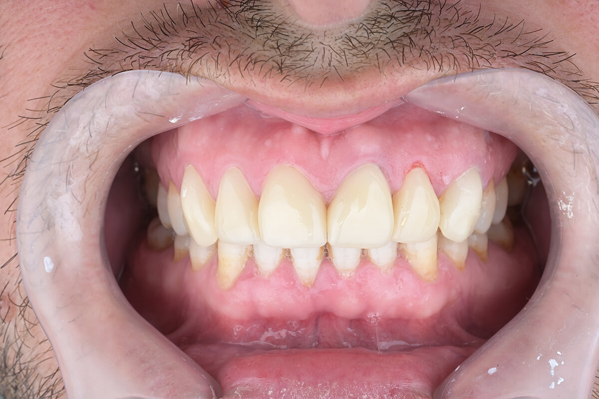 <span class="bt_bb_before_after_image_before_text">قبل</span>