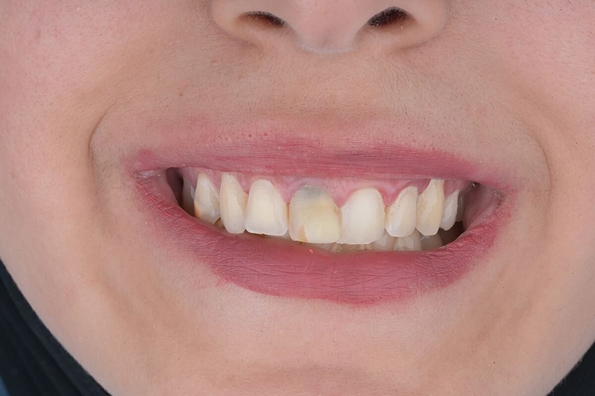 <span class="bt_bb_before_after_image_before_text">قبل</span>